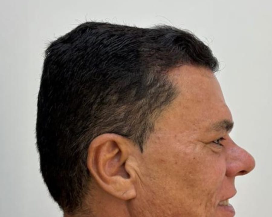 Resultado depois — caso 1