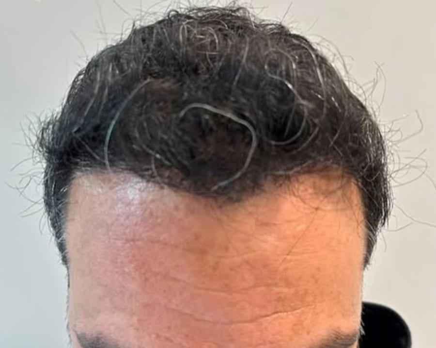 Resultado depois — caso 3