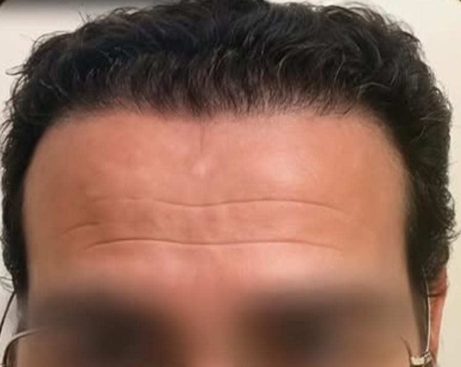 Resultado depois — caso 5
